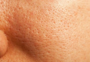 Naturlig behandling för vidgade porer