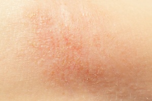 Sju naturliga kurer för att motverka torr hud
