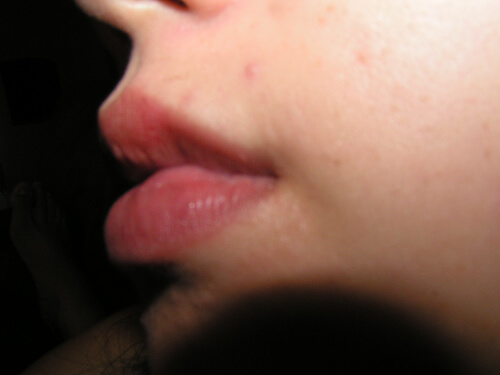 Bikarbonat mot munsår