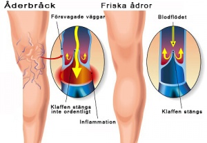 Huskurer mot åderbråck: effektiva behandlingar