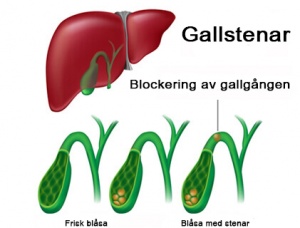 Vilka är egentligen symptomen på gallsten?