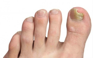 Nagelsvamp på stortån