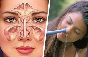 Enkelt och naturligt sätt att behandla bihåleinflammation