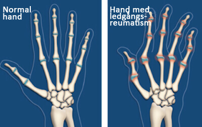 6 åtgärder mot artrit som kan lindra dess inverkan