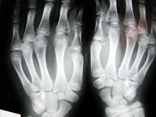 röntgenbild av artros