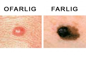 Leverfläckar - här är allt du bör veta - Steg för Hälsa