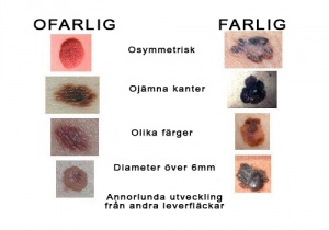 kliande födelsemärke på ryggen kliande födelsemärke på ryggen