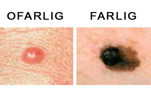 leverfläckar på huden