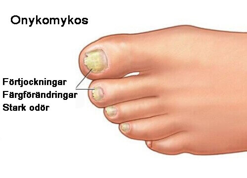 Onykomykos: motverka nagelsvamp naturligt