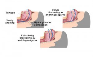 Snarkning? Övningar och tips till dig