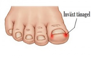 Vanor som hjälper dig att undvika inväxta tånaglar