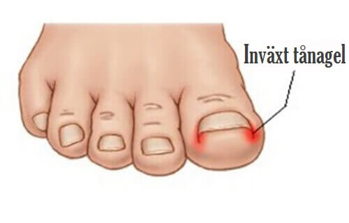 Tånagel