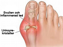 Faran med urinsyra: kontrollera dess nivåer