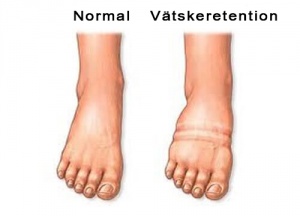 Hur man bekämpar vätskeretention