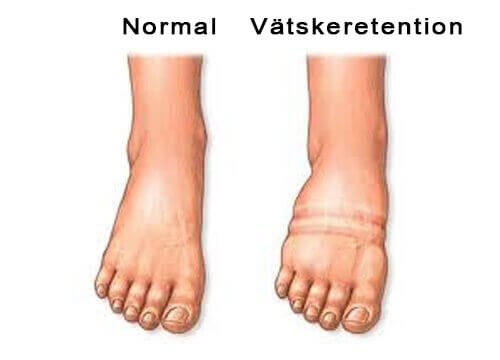 Vätskeretention