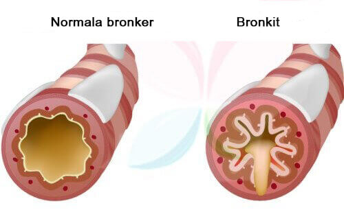 Hosta kan vara symptom på bronkit