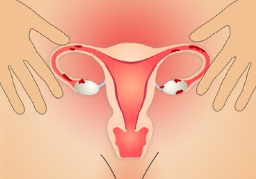 Lindra endometrios med hjälp av näring