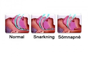 Hur man slutar snarka - de mest effektiva metoderna