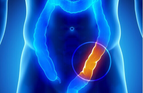 Tjocktarmscancer är relativt vanligt men kan till viss del förebyggas.