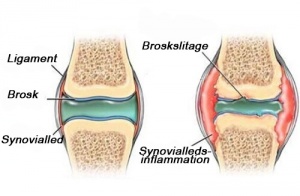 Hur man motverkar smärta vid slitage av brosk