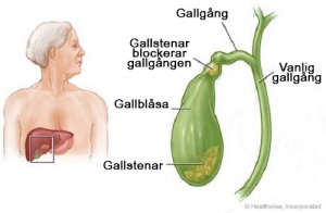 Hur känner man igen symtom på gallsten?
