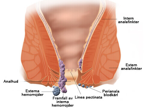 Diagram av hemorrojder