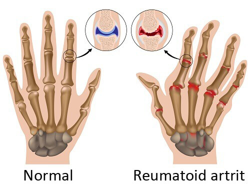 Reumatoid artrit