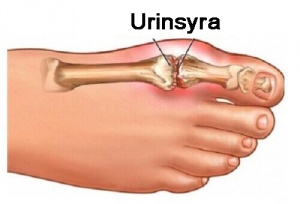 Frukter som minskar mängden urinsyra