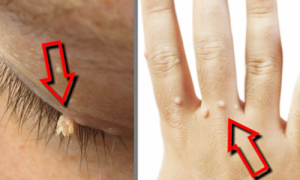 Effektiva kurer för att ta bort vårtor