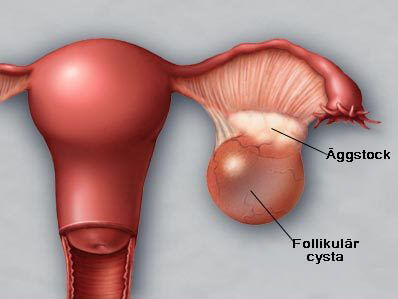 Upptäckt och förebyggande av cystor på äggstockarna