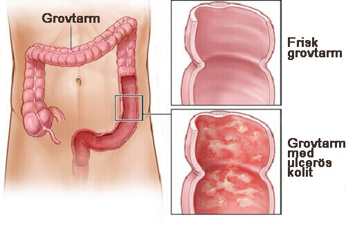 grovtarm-med-ulcerös-kolit