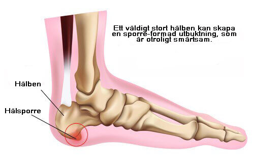 Hur du kan förebygga hälsporre effektivt