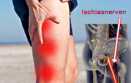 Ischias Ischias
