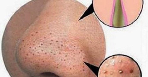 Gör dig av med finnar och pormaskar naturligt