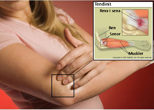 Hur du behandlar tendinit snabbt och naturligt