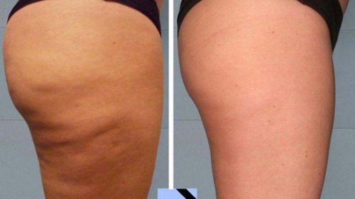 Hemmagjorda behandlingar mot celluliter