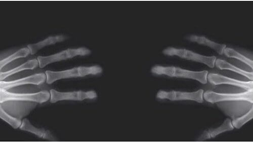 Det här händer när du knäcker med fingrarna