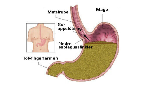 gastroesofagal refluxsjukdom