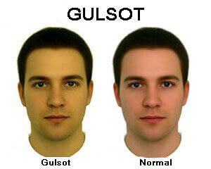 gulsot