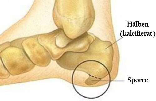 Hälsporre: symtom och behandling