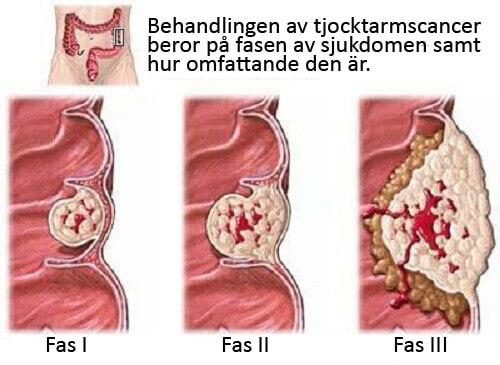 Vad du behöver veta om tjocktarmscancer