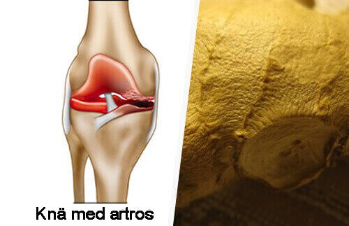 Hur du lindrar symptomen på artros