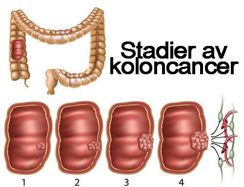 Stadier av koloncancer