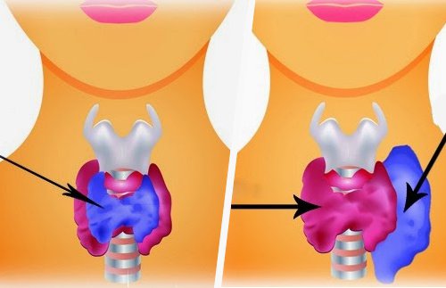 Skillnaden mellan hypotyreos och hypertyreos
