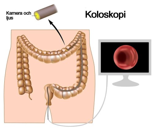 Koloskopi är en undersökning av tarmen.