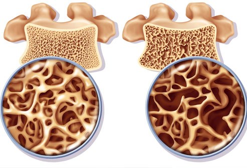 Osteoporos hos kvinnor: förebygg och behandla Osteoporos hos kvinnor: förebygg och behandla