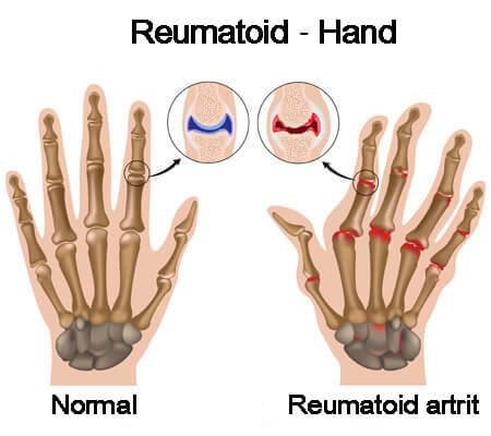 Brist på vatten kan avsevärt öka problem i lederna