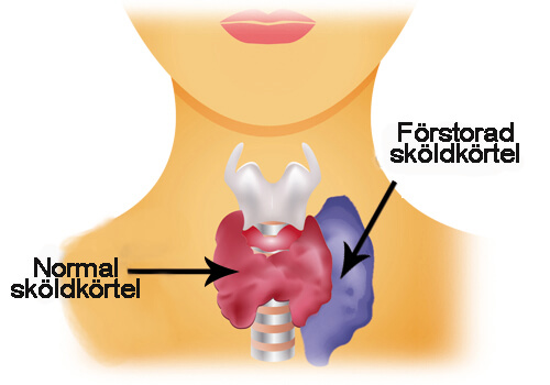 Hypertyreos – överaktiv sköldkörtel