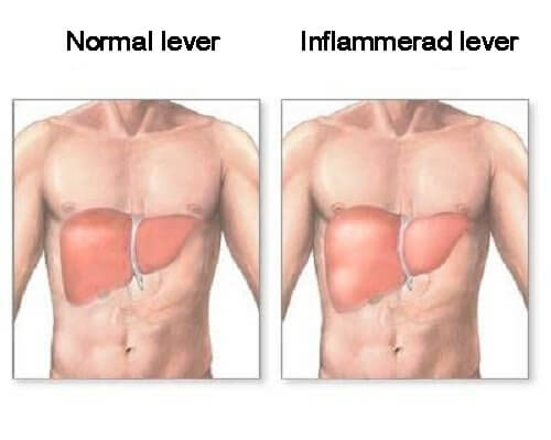 Leverinflammation: Symtom och rekommenderad kost