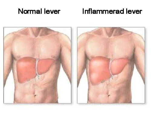 Är din lever inflammerad? Vi listar tecknen